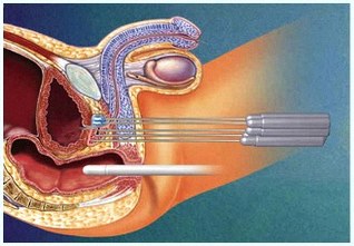 Prostate Cryotherapy-