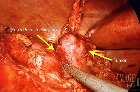 Kidney-Tumor