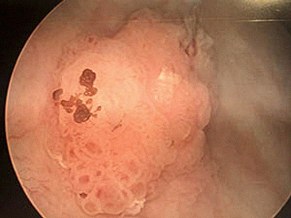 Bladder Tumor