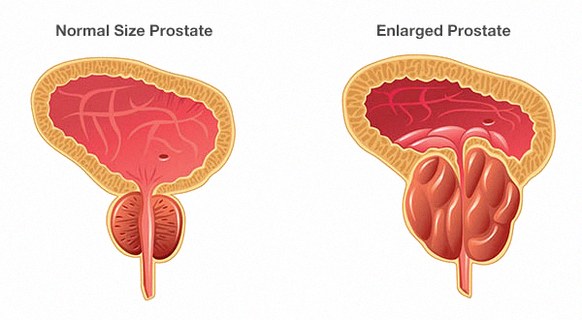 Normal & Enlarged Prostate (BPH)