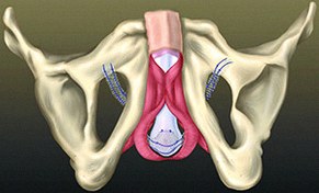AdVance Male Sling Surgical System