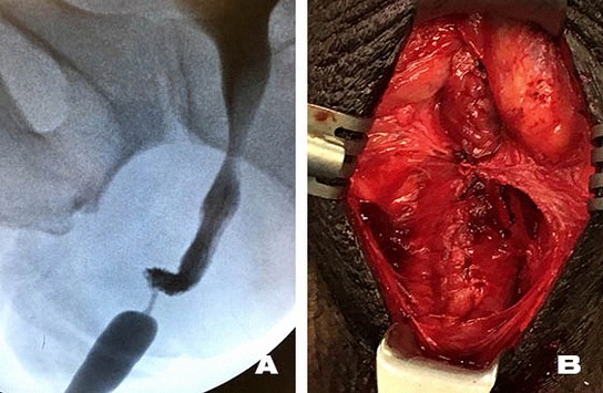 urethral stricture urethroplasty
