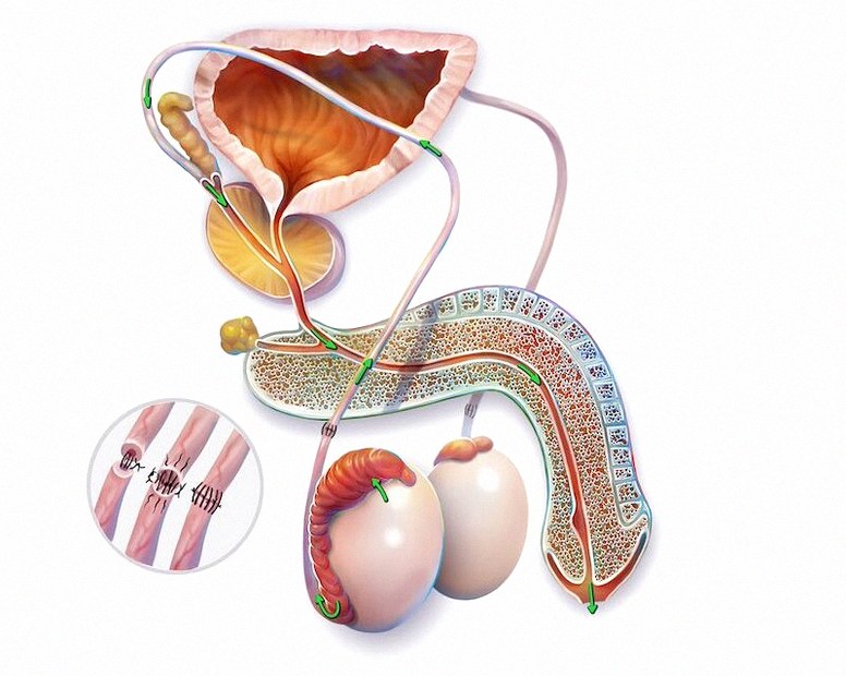 >What Does a Vasectomy Reversal Entail?
